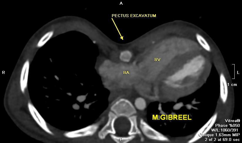 MGibreel1's tweet image. Pectus excavatum ,,, what to u need to be commented in your report ...
From my archieve
@AlkashkariWail