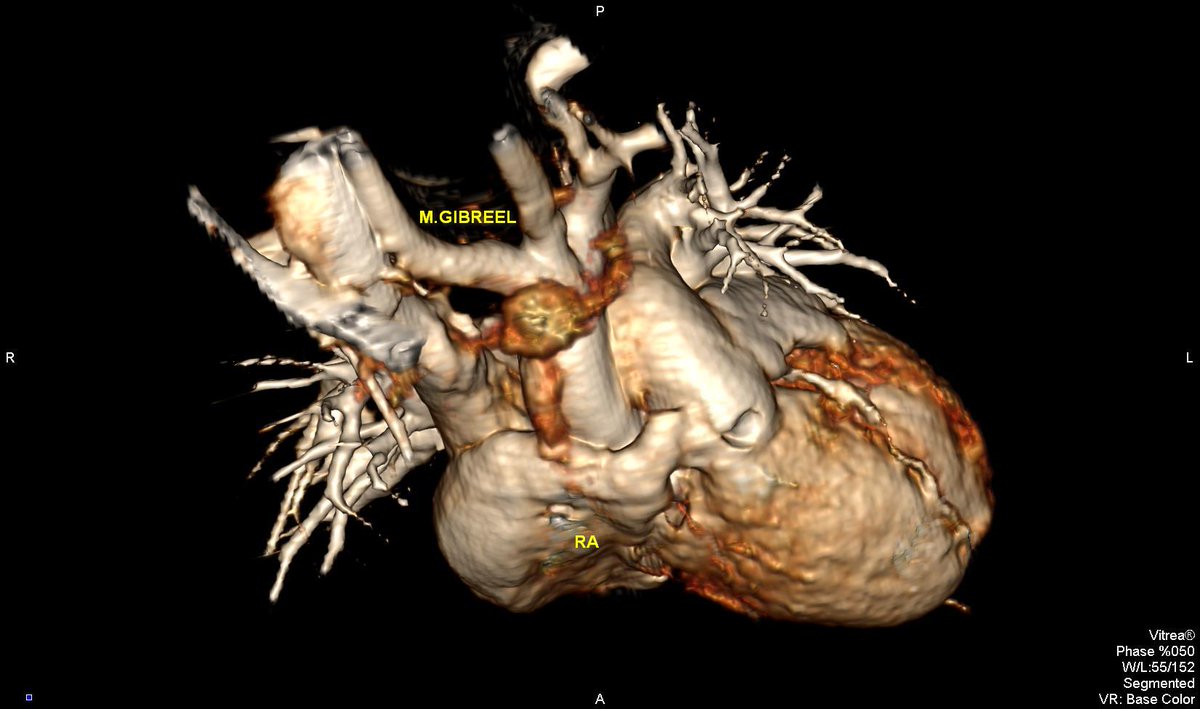 MGibreel1's tweet image. Pectus excavatum ,,, what to u need to be commented in your report ...
From my archieve
@AlkashkariWail