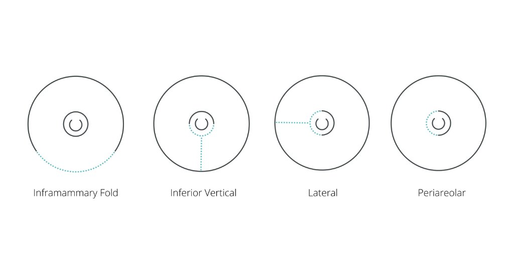 annepeledmd's tweet image. Fortunately, most mastectomies can now be performed as nipple-sparing mastectomies. We try to choose incisions for NSM that place scars in hidden locations or areas where they’ll heal well with minimal daily reminder of surgery. Here are the most common ones used #hiddenscar