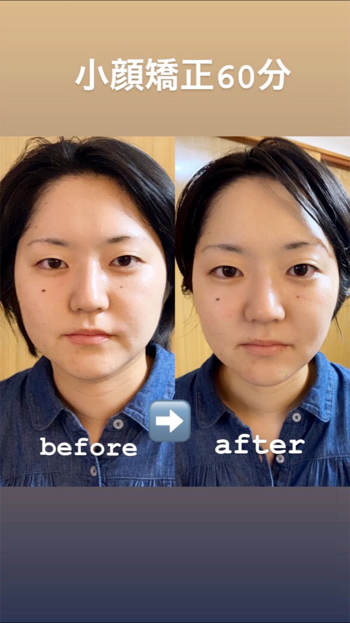 エリー 手技による小顔矯正のbefore After 小顔の事ならお任せください 豪徳寺 豪徳寺小顔サロン 小顔サロン ゴッドハンド コンプレックス解消 小顔は七難隠す 女性可 男性可 東京小顔サロン 世田谷小顔サロン T Co