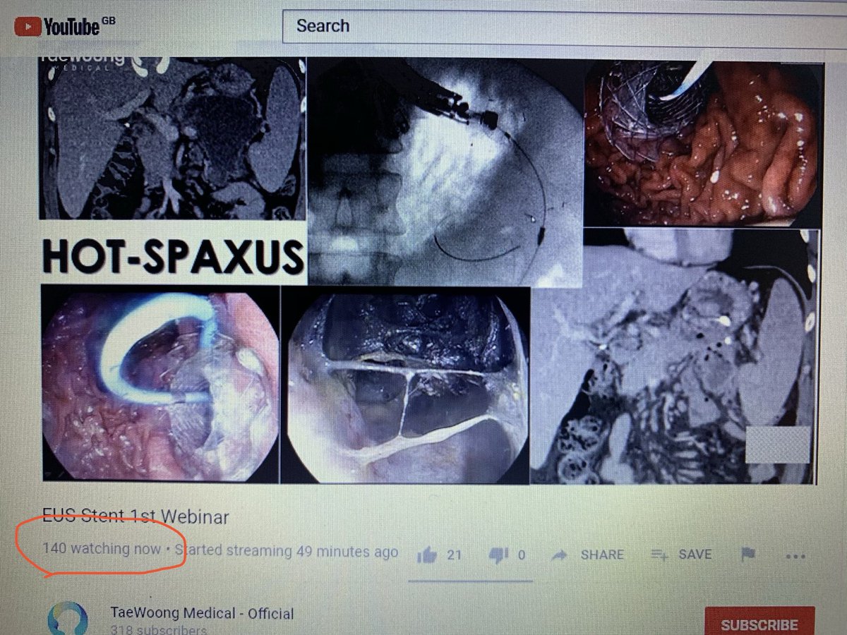 GiorgiaAla's tweet photo. Excellent attendance and great webinar where Prof Giovannini is sharing his experience in hepaticogastrostomy cases with the GIOBOR stent as well as with our cistogastrostomy stents, #SPAXUS and #HOT_SPAXUS

#Endoscopy #EUS #Stents #SEMS #Giobor #Nagi #LAMS ⁦@AquilantGI⁩ https://t.co/HN9IDsWW2R