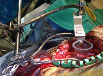 vycormedical's tweet photo. Our Extension Arm is compatible with various retractor systems, such as Leyla, Greenberg, BUDDE Halo, Mitaka Pneumatic, and DORO LUNA #vycor #vycormedical #vbas #viewsite #minimallyinvasive #neurosurgery #extensionarm https://t.co/quRFTZrA2d