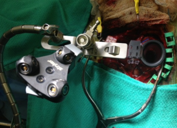 vycormedical's tweet photo. Our Extension Arm is compatible with various retractor systems, such as Leyla, Greenberg, BUDDE Halo, Mitaka Pneumatic, and DORO LUNA #vycor #vycormedical #vbas #viewsite #minimallyinvasive #neurosurgery #extensionarm https://t.co/quRFTZrA2d