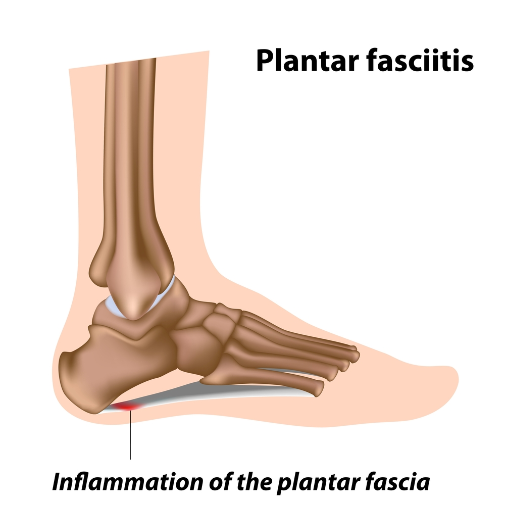 DYK that in almost all patients w/#plantarfasciitis, conservative medical approaches are successful in healing the injury? Generally, non-surgical treatments will be attempted for 6-12 months prior to consideration of surgical treatment. View our options: sportsfootankle.com/plantar-fascii…