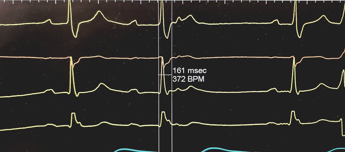 J_Colley_MD's tweet photo. Nice result today with His bundle pacing on a highly symptomatic gentleman from the Mississippi delta
#EPeeps #Mississippi #hisbundle #heartblock #jhc @JacksonHeartMS @StDomHospital https://t.co/w18K3jV4GA