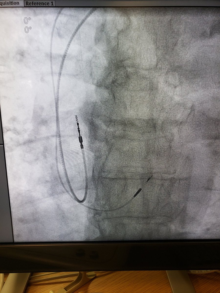 J_Colley_MD's tweet photo. Nice result today with His bundle pacing on a highly symptomatic gentleman from the Mississippi delta
#EPeeps #Mississippi #hisbundle #heartblock #jhc @JacksonHeartMS @StDomHospital https://t.co/w18K3jV4GA