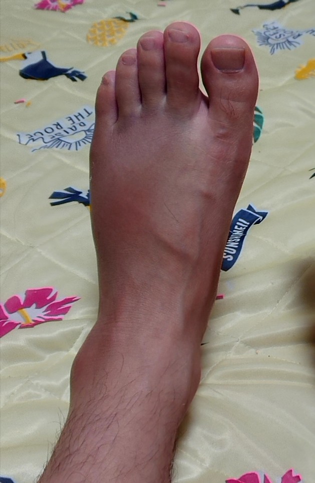 Sumi Ism 35 第5中足骨骨折 実際はこれより2まわり以上腫れました 骨もズレており 完治まで3ヶ月かかりました