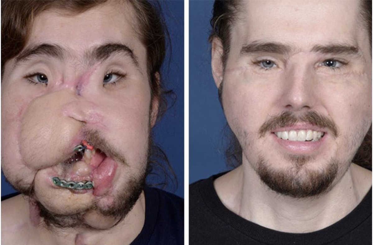 zangeets's tweet image. Les chirurgiens sont vraiment pas payés à rien faire (le gars avait tenté de se suicider en se tirant une balle dans la tête)