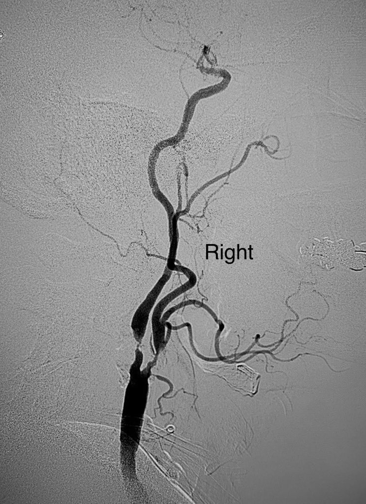 t_intheleadcoat's tweet photo. Curious how y’all would manage #stringsign Carotid stenosis. NO TIA/ stroke. Bruit on physical led to work up. 

70’s, HTN, hyperlipidemia on Rx

#Irad #MedTwitter #cardiotwitter  @SIRRFS @VascularSVS @ACCinTouch @SNISinfo @RKTvascular @CAIRweb @pairsmedia @VMJ_SVM @SVM_tweets https://t.co/aJdXCxsA01