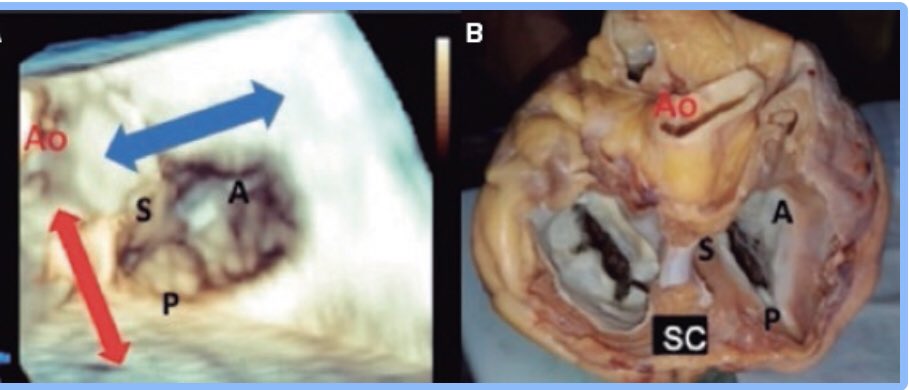 MA Garcia Fernandez (@maecocardio) on Twitter photo Excelente  revisión del tratamiento percutaneo de la insuficiencia tricuspide: valor excepcional de la imagen ecocardiografica: Muy bueno!, Vanesa y resto  de amigos recintervcardiol.org/es/articulo-es… Excelente  revisión del tratamiento percutaneo de la insuficiencia tricuspide: valor excepcional de la imagen ecocardiografica: Muy bueno!, Vanesa y resto  de amigos recintervcardiol.org/es/articulo-es…
