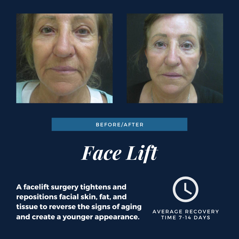 DrEDomanskis's tweet photo. Learn more about the Face Lift procedure on our website! https://t.co/HGShNNTZFG https://t.co/mcFNlEbr9S
