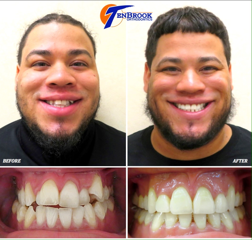 TenBrook Orthodontics on Twitter "𝐘𝐨𝐮𝐫 𝐬𝐦𝐢𝐥𝐞 𝐢𝐬 𝐭𝐡𝐞 𝐟𝐢𝐫𝐬𝐭 𝐭𝐡𝐢𝐧𝐠 𝐩𝐞𝐨𝐩𝐥𝐞