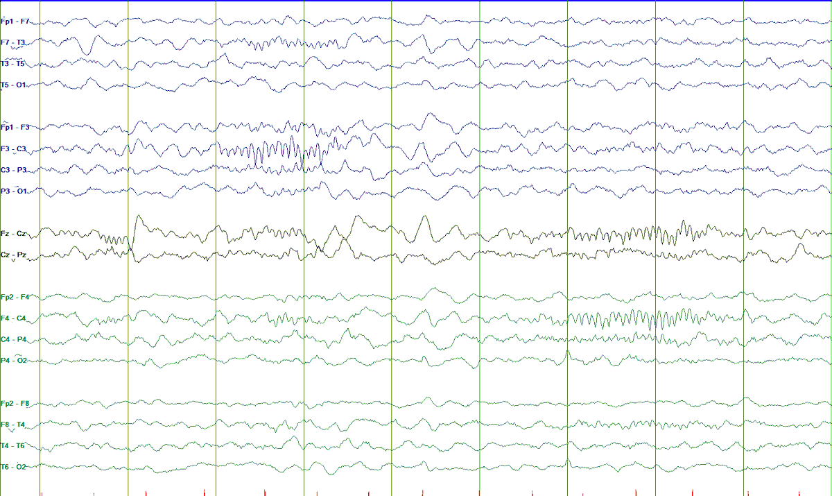 Currently reading a study with one of my favorite findings, so let's play an EEG game:If I will report this as "normal," what is the OLDEST this patient can be? Vote in the next tweet !  #Tweetorial to follow  #MedEd  #neurology  #MedTwitter  #FOAMed