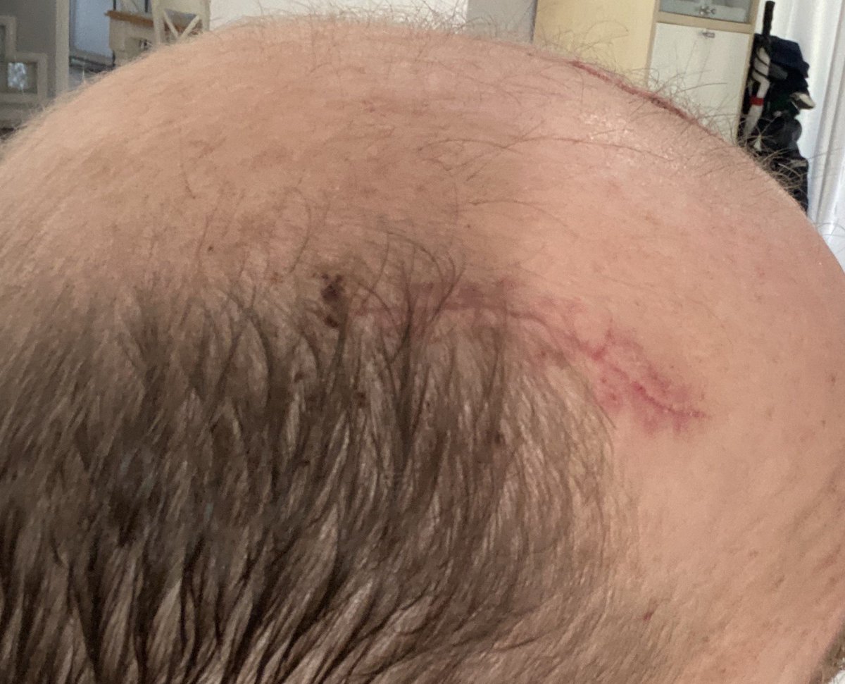 MattyGuyatt's tweet photo. Since my small part on @InsideThe_Ropes podcast last week the messages from strangers have been awesome. People touched by the story in so many different ways....the miracle I survived, my kids being amazing in crisis, encouraging dads to be dads etc...thank you all #stitchesout https://t.co/MyyGNeC7uL