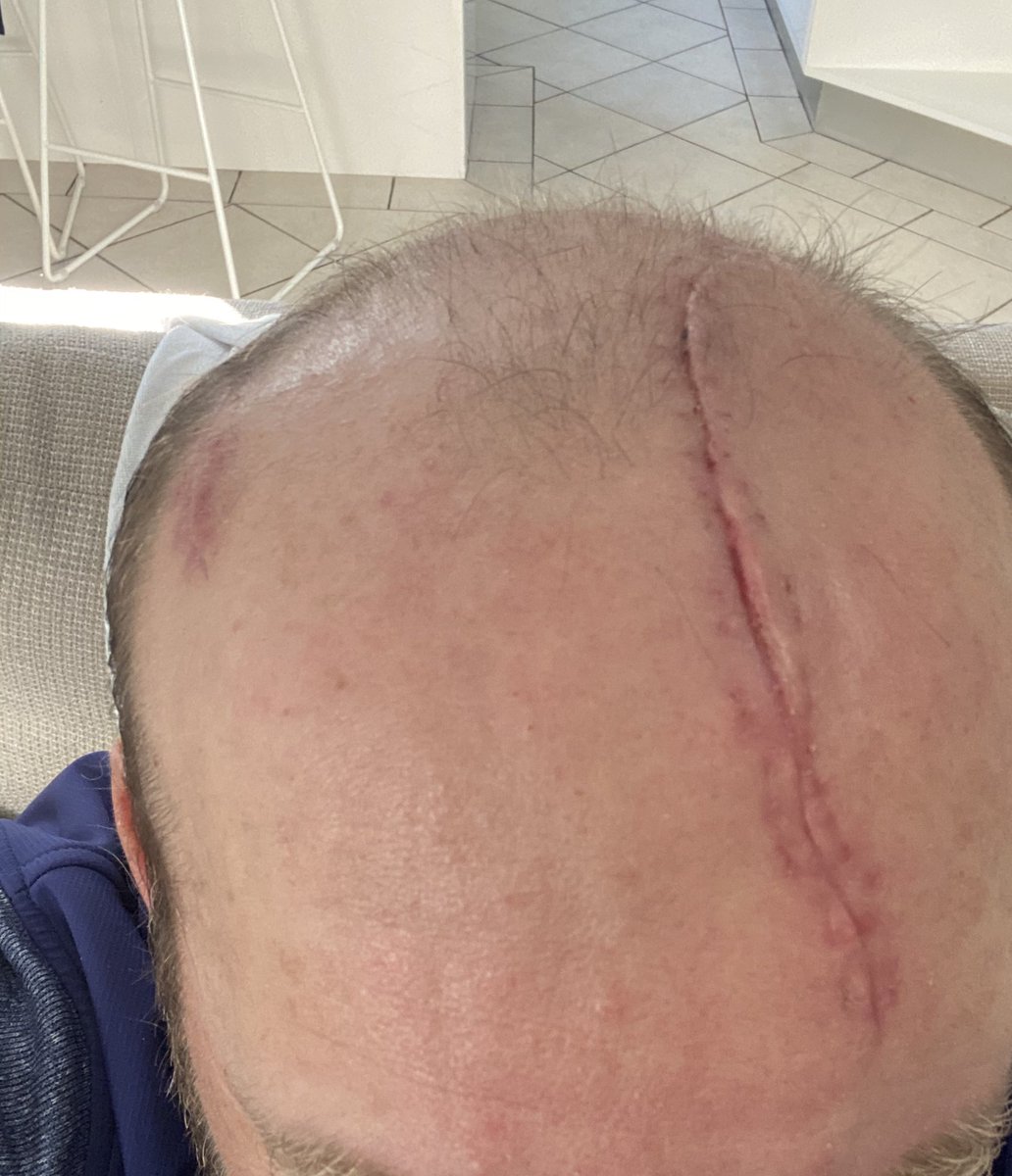 MattyGuyatt's tweet photo. Since my small part on @InsideThe_Ropes podcast last week the messages from strangers have been awesome. People touched by the story in so many different ways....the miracle I survived, my kids being amazing in crisis, encouraging dads to be dads etc...thank you all #stitchesout https://t.co/MyyGNeC7uL
