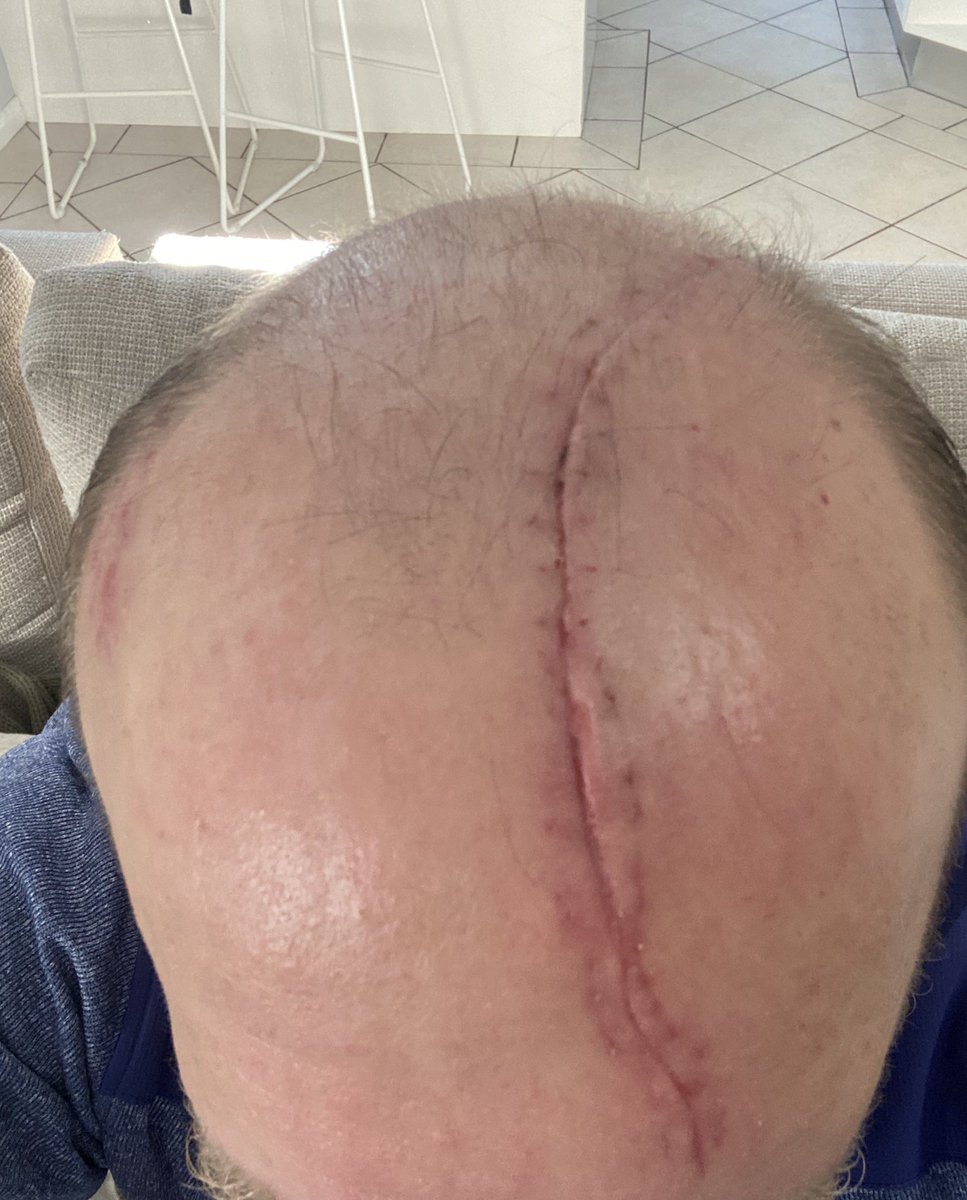 MattyGuyatt's tweet photo. Since my small part on @InsideThe_Ropes podcast last week the messages from strangers have been awesome. People touched by the story in so many different ways....the miracle I survived, my kids being amazing in crisis, encouraging dads to be dads etc...thank you all #stitchesout https://t.co/MyyGNeC7uL
