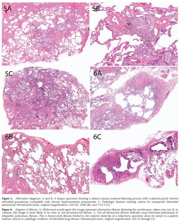 ArchivesPath's tweet photo. Smith et al., "Histopathologic Assessment of Suspected Idiopathic Pulmonary Fibrosis: Where We Are and Where We Need to Go" #EarlyOnline #Pulmpath https://t.co/jpdCfDfAaT https://t.co/GfPa658Arm