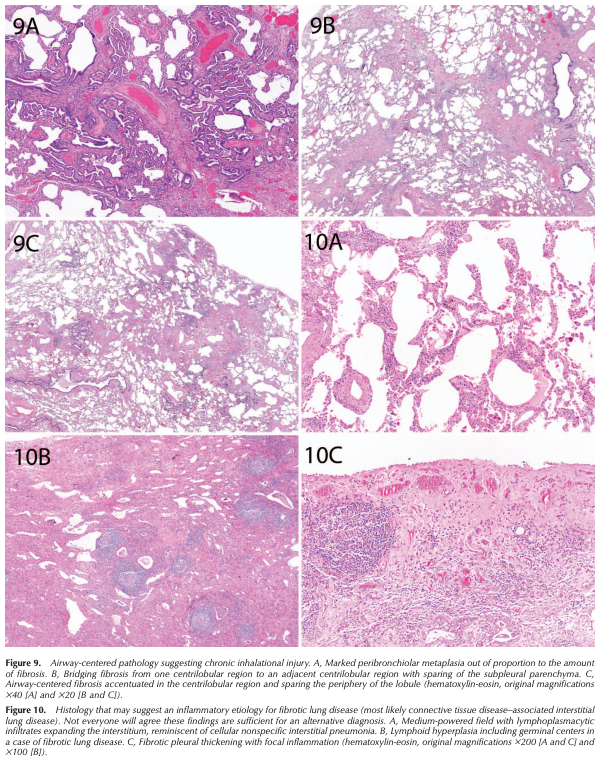 ArchivesPath's tweet photo. Smith et al., "Histopathologic Assessment of Suspected Idiopathic Pulmonary Fibrosis: Where We Are and Where We Need to Go" #EarlyOnline #Pulmpath https://t.co/jpdCfDfAaT https://t.co/GfPa658Arm