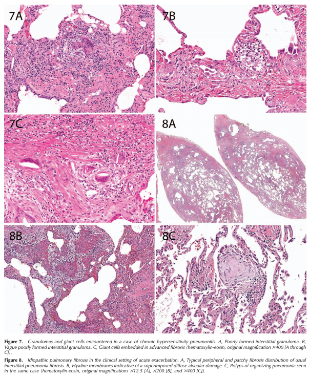 ArchivesPath's tweet photo. Smith et al., "Histopathologic Assessment of Suspected Idiopathic Pulmonary Fibrosis: Where We Are and Where We Need to Go" #EarlyOnline #Pulmpath https://t.co/jpdCfDfAaT https://t.co/GfPa658Arm