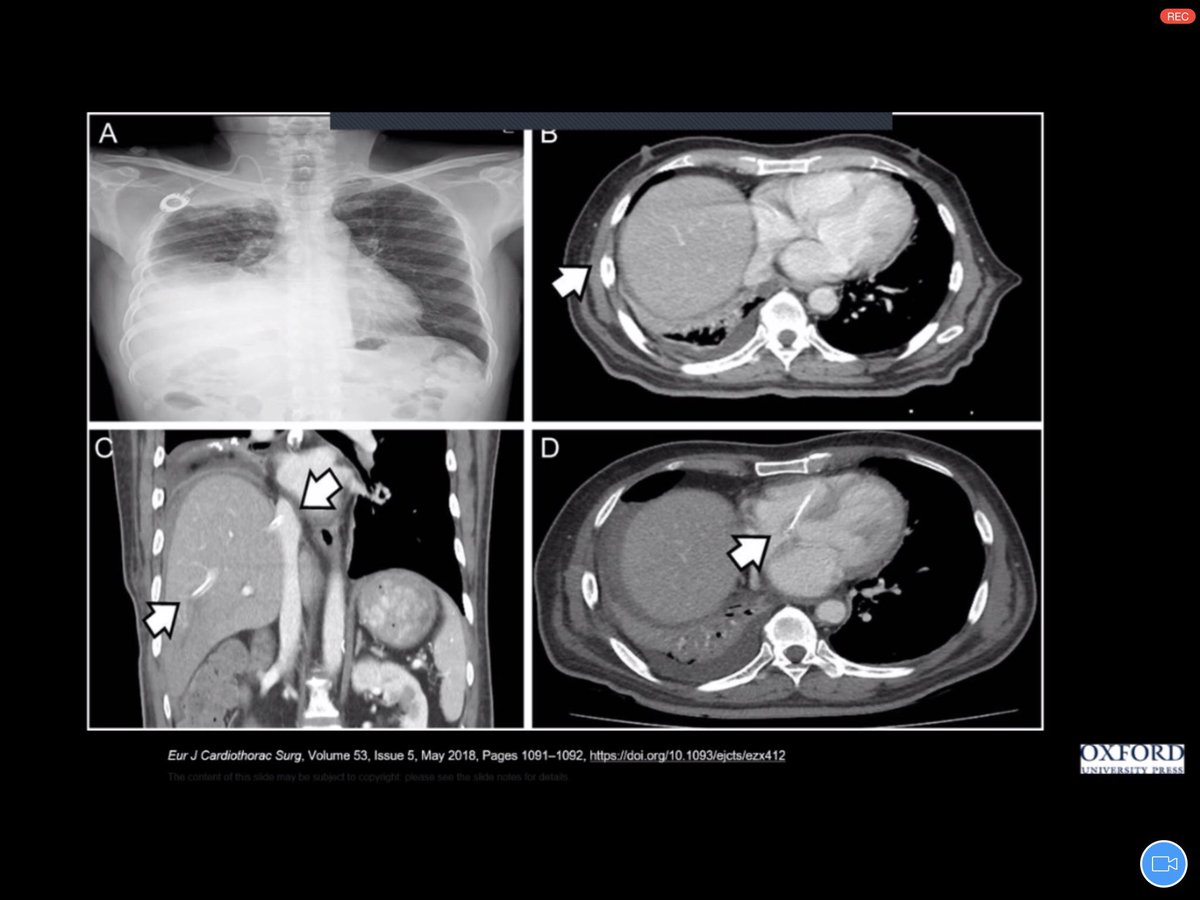 sfaiz212's tweet photo. @BCM_Lung Dr Steve Bujarski teaching insertion and complication management for #IPC #Pleura #SWRegBootCamp One of my favorite #PCCM procedures https://t.co/fWPp8g4Sw6
