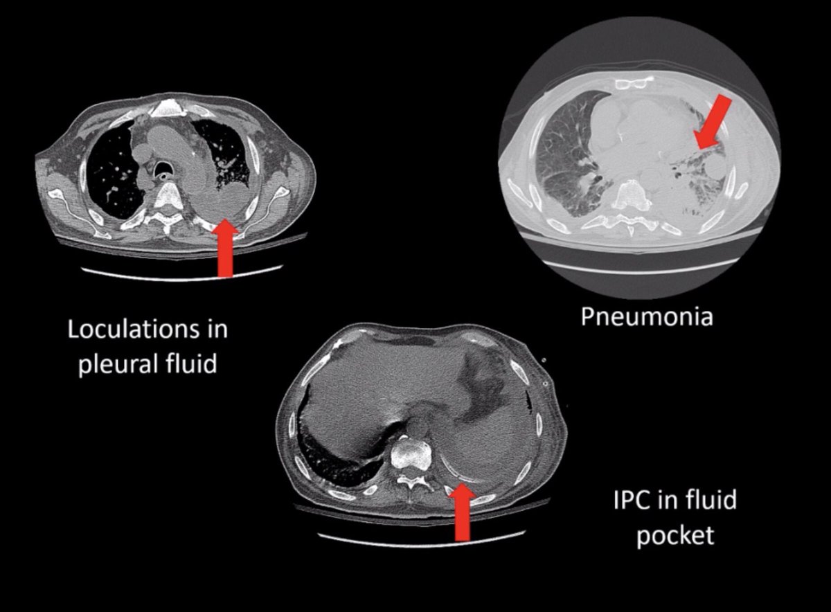 sfaiz212's tweet photo. @BCM_Lung Dr Steve Bujarski teaching insertion and complication management for #IPC #Pleura #SWRegBootCamp One of my favorite #PCCM procedures https://t.co/fWPp8g4Sw6
