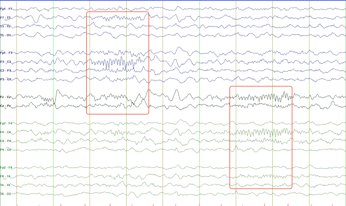 The most striking feature of the example above is that SS occur first over the left central region (C3/Cz) and about 2 seconds later, they occur over the right central region (C4/Cz). We say these SS are ASYNCHRONOUS