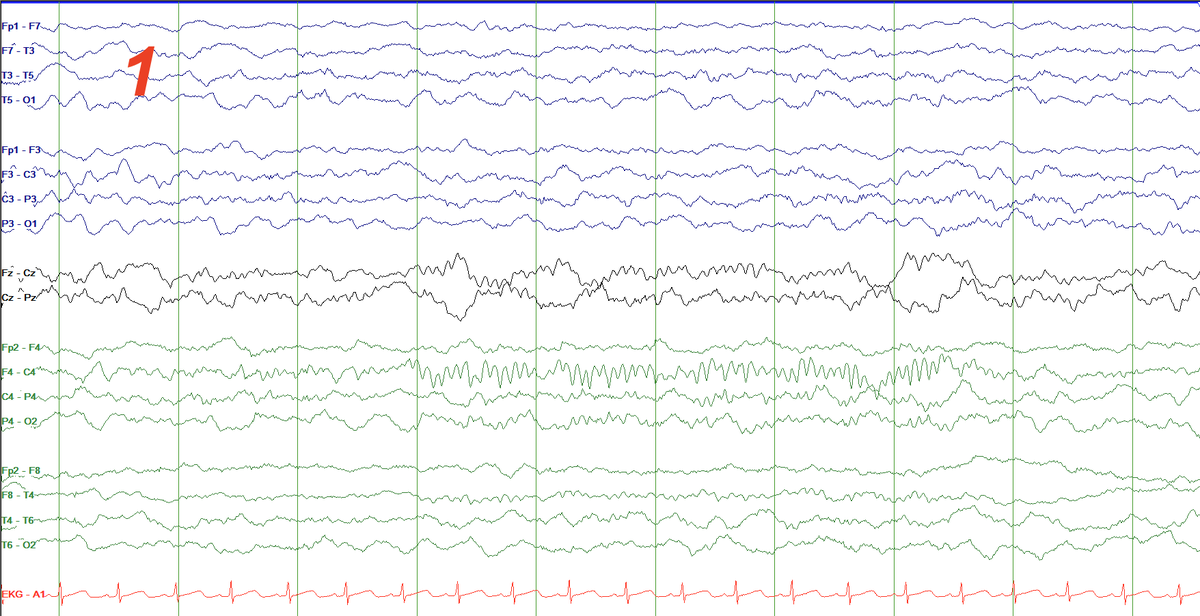 SS also change as infants go thru sleep from lighter to deeper stages! Look at 3 captures from the same baby (CA 47-week) as the night progresses: asynchronous SS (R only) more synchronous SS (L and R co-occur, but L better formed first 2-3 seconds) fully synchronous!