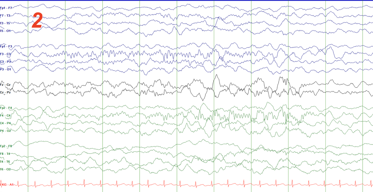 SS also change as infants go thru sleep from lighter to deeper stages! Look at 3 captures from the same baby (CA 47-week) as the night progresses: asynchronous SS (R only) more synchronous SS (L and R co-occur, but L better formed first 2-3 seconds) fully synchronous!