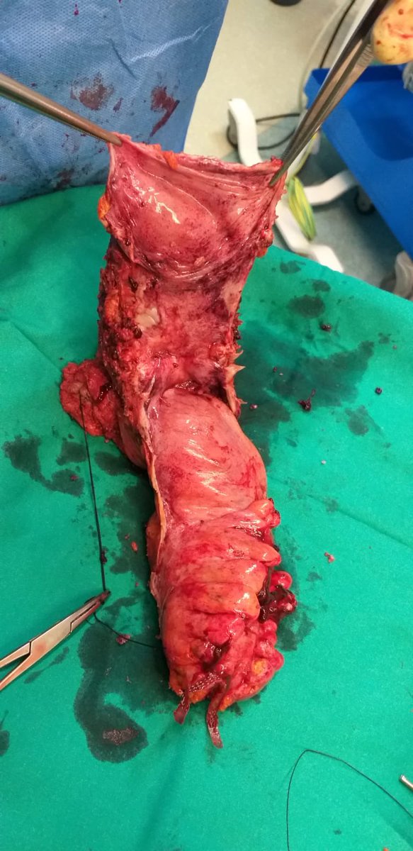 alarjosan's tweet photo. Complete laparoscopic  pelvic exenteration, less morbidity in a extremely complex procedure in @HUReinaSofia @operarelcancer @ESSOnews @SPeritoneum @me4_so @aecirujanos https://t.co/cNcekngccg
