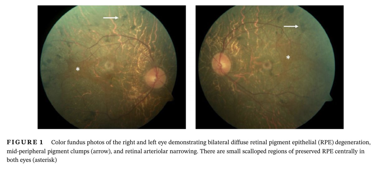 JIMD_Editors's tweet photo. New in JIMD Reports, Benson et al demonstrate improved electroretinographic responses following dietary intervention in a patient with Refsum disease. Showing that Phytanic Acid restriction can help eye disease in #refsum
#openaccess
https://t.co/zGLP5LVJBx https://t.co/at56R2EE5z