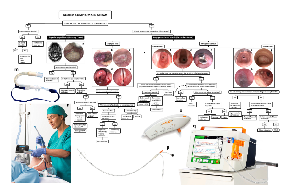 Imran Ahmad and colleagues provide a common framework to for creating multidisciplinary shared-airway management plans. Tritube and Evone are described to be of value in minimizing aerosol generation
ncbi.nlm.nih.gov/pmc/articles/P…