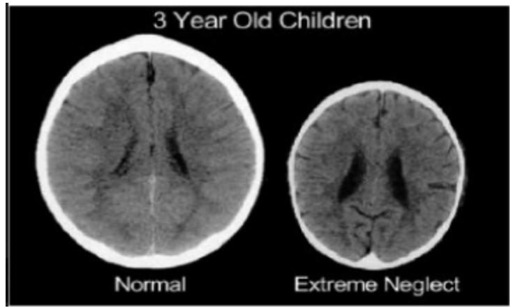 Vi que se estaba debatiendo el tema de igualdad de oportunidades y quería compartir esto. Cuando hice mi tesis, <a href="/LustembergC/">Cristina Lustemberg</a> me mostró esta foto. Los cerebros de 2 niños de 3 años, el de la izq nació ambiente sano, el de la derecha contexto crítico. ¿Igualdad de oportunidades?