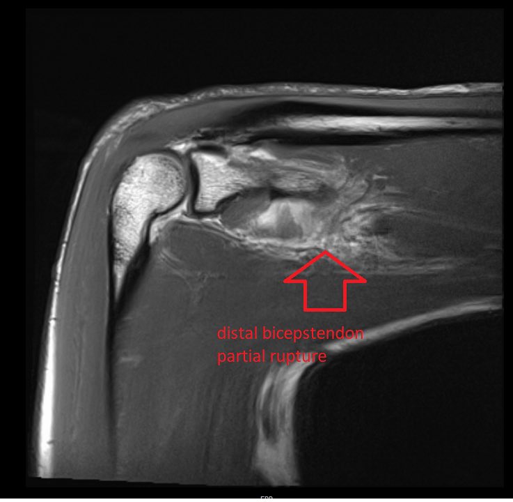 Partial rupture of the distal biceps brachii tendon - cast for 6 weeks and 1 time #arthrexacp #acptendo #softtissuerepair System #mskus #pocus #pocushub #tendonrupturerepair #ultrasoundguidedinjection #gehealthcare #s7r3