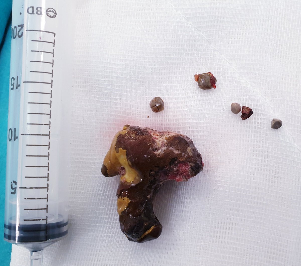 drahmetsahan's tweet photo. 55 yo, male, right staghorn kidney stone; 5cm, #retroperitoneal #laparoscopic #pyelolithotomy, stone free 👌, 90 min. https://t.co/BPKCFXgz2r
