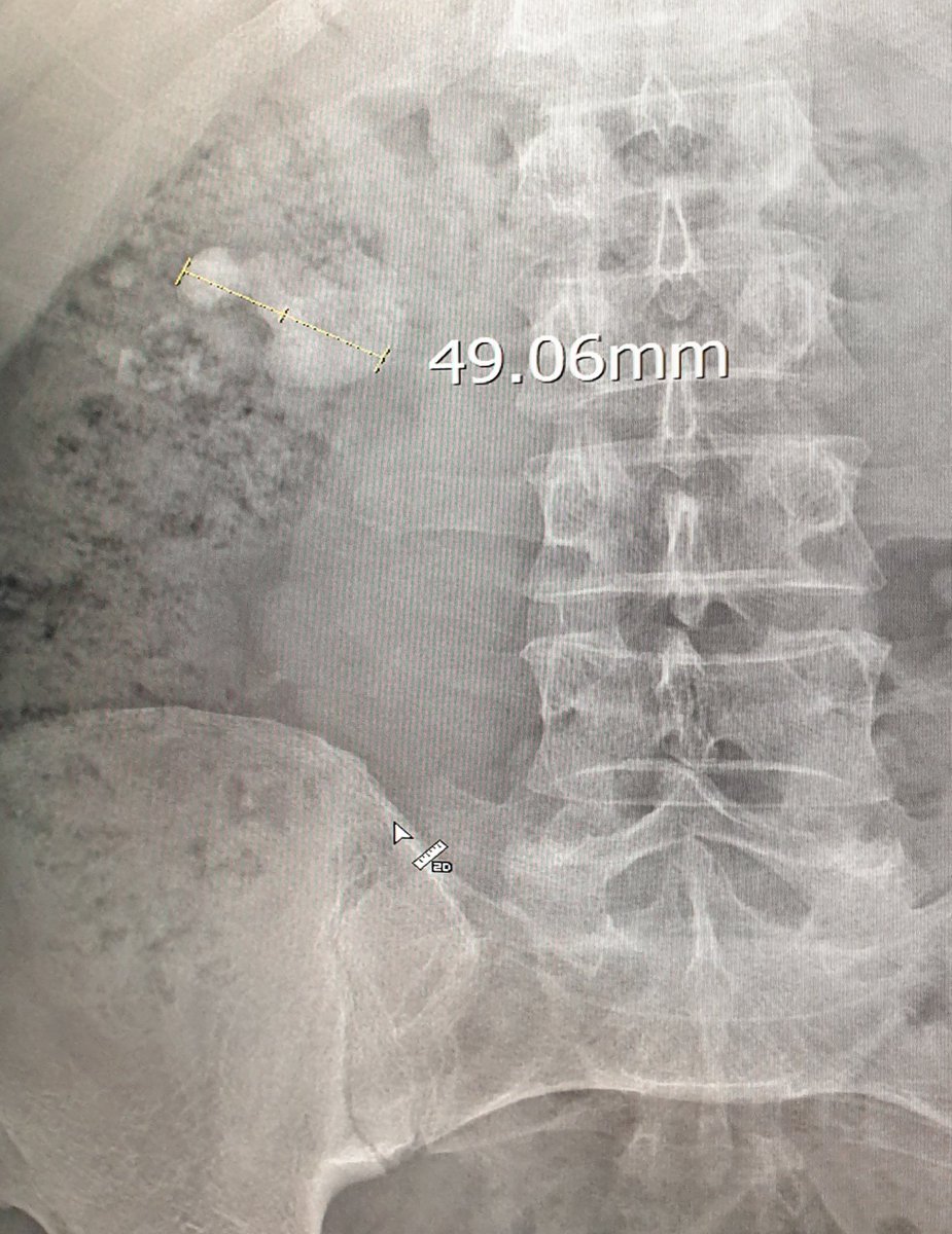 drahmetsahan's tweet photo. 55 yo, male, right staghorn kidney stone; 5cm, #retroperitoneal #laparoscopic #pyelolithotomy, stone free 👌, 90 min. https://t.co/BPKCFXgz2r