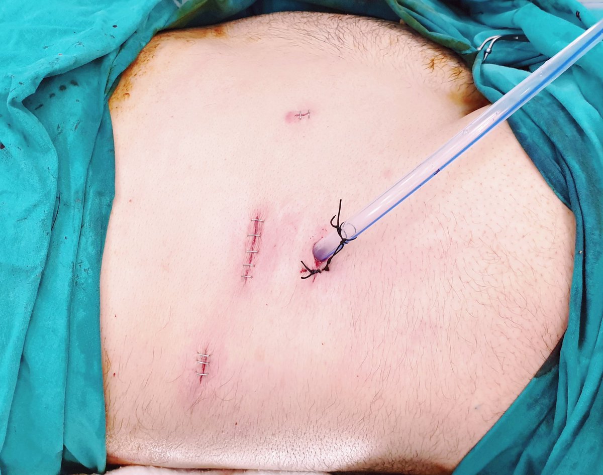 drahmetsahan's tweet photo. 55 yo, male, right staghorn kidney stone; 5cm, #retroperitoneal #laparoscopic #pyelolithotomy, stone free 👌, 90 min. https://t.co/BPKCFXgz2r