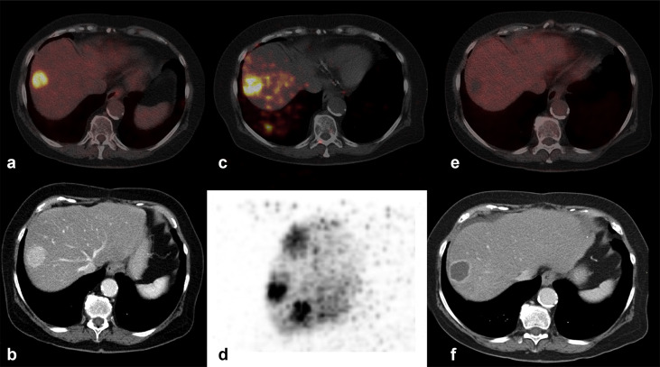 Yttrium-90 Radioembolization in Intrahepatic Cholangiocarcinoma: A Multicenter Retrospective Analysis | ow.ly/9J3p50Amu5j #irad