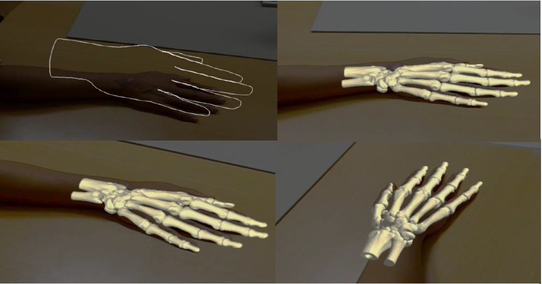 ETZ In-Hospital 3D Lab (@3dlab_etz) on Twitter photo One of our technical medicine students is doing her thesis on markerless registration of holograms onto patients. We are working with the <a href="/HoloLens/">Microsoft HoloLens</a> 2, together with <a href="/3DLabRadboudumc/">3D Lab Radboudumc</a>. #Augmentedreality #hololens #markerless #medtech #innovation #mixedreality #healthinnovation One of our technical medicine students is doing her thesis on markerless registration of holograms onto patients. We are working with the <a href="/HoloLens/">Microsoft HoloLens</a> 2, together with <a href="/3DLabRadboudumc/">3D Lab Radboudumc</a>. #Augmentedreality #hololens #markerless #medtech #innovation #mixedreality #healthinnovation