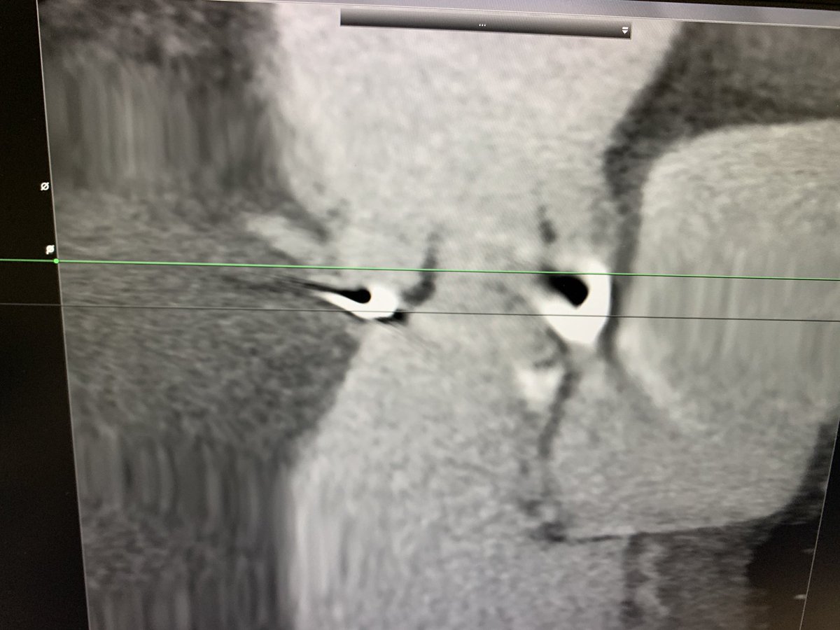 alaa__masri's tweet photo. VIV case in #MITROFLOW 25. RCA height 5 mm.Using #3MENSIO, simulation of #TAVI valve and mesurment of the VTC distance from the simulated valve to the RCA ostium 6,1 mm(>6mm) will allow a strategy of protection with a wire only, without stent (No #CHIMNEY directly nor #BASILICA) https://t.co/6S6DCyh2vK