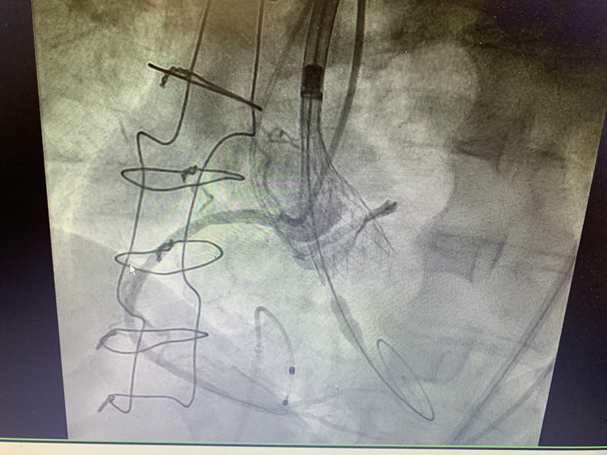 alaa__masri's tweet photo. VIV case in #MITROFLOW 25. RCA height 5 mm.Using #3MENSIO, simulation of #TAVI valve and mesurment of the VTC distance from the simulated valve to the RCA ostium 6,1 mm(>6mm) will allow a strategy of protection with a wire only, without stent (No #CHIMNEY directly nor #BASILICA) https://t.co/6S6DCyh2vK