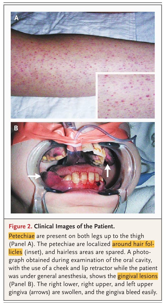 Scurvy 🔘Clinical manifestation of vit C deficiency 🔸Mucosal bleeding, easy bleeding 🔸
