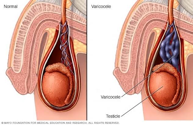 After the repeated cases I saw in the clinic, I think it is important to address this. A lot of men have "worms" in the body but they don't know until it has caused a lot of damage.VARICOCELE is becoming an important cause of reduced fertility in many young men and should be...