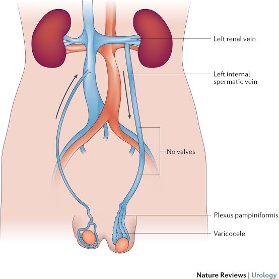 Varicocele is the tortuous dilation of the veins that is supposed to carry deoxygenated blood and waste products from the testes back to the heart,hence these waste products remain and damage the sperm tht is formed in the testes.Also there is a rise in the temp which further...