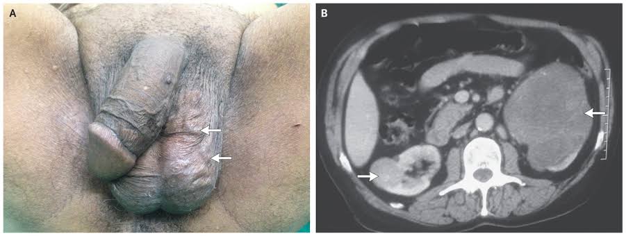 So if you are a man, kindly touch ur scrotum and see if u feel something that feels like a "bag of worm" as it is called. Save ur sperm cells today, save ur generation. Seek help on time before it becomes too late. Kindly RT.