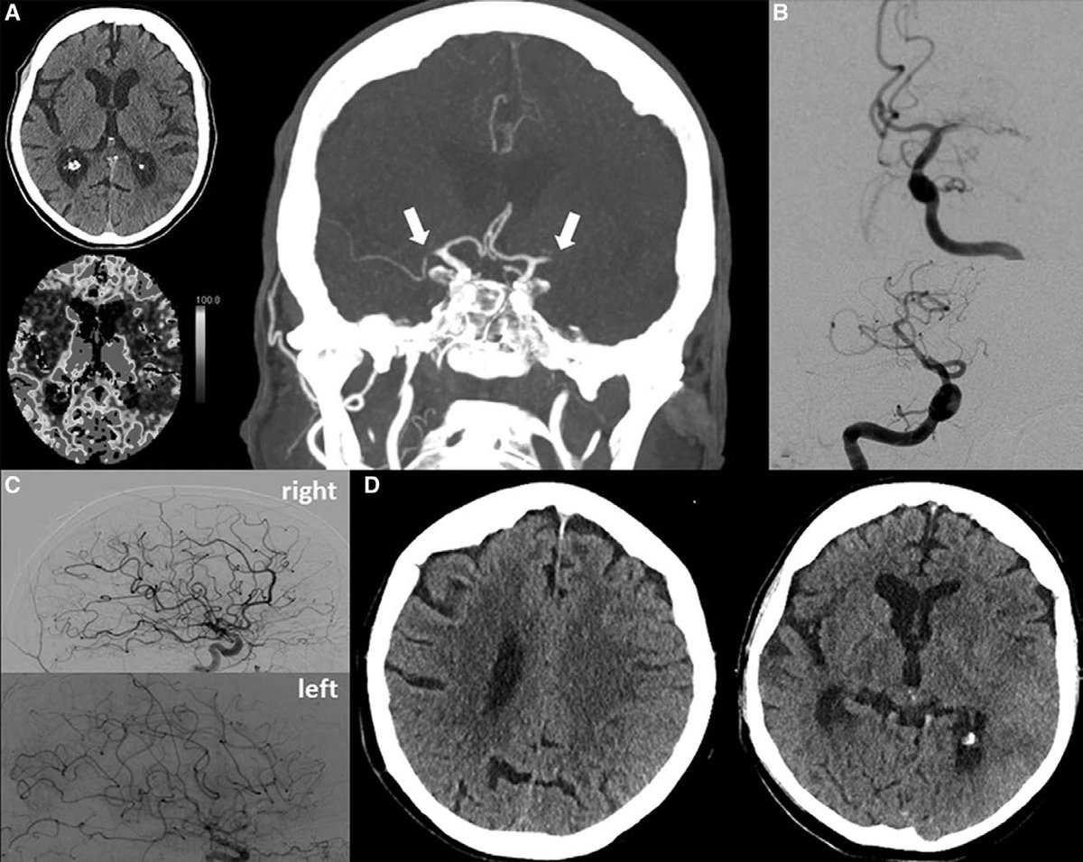 Primary Multivessel Occlusions Treated With Mechanical Thrombectomy: A Multicenter Analysis and Systemic Literature Review #stroke ow.ly/KrbK50Aydib
