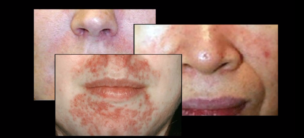 7NewsDC's tweet photo. ICYMI: Dermatologists have discovered the coronavirus pandemic has sparked a skin condition that has patients flocking to their offices. 

They've named it "Maskne."

STORY: https://t.co/Le6T87yrwN https://t.co/d9T0HAYNUP