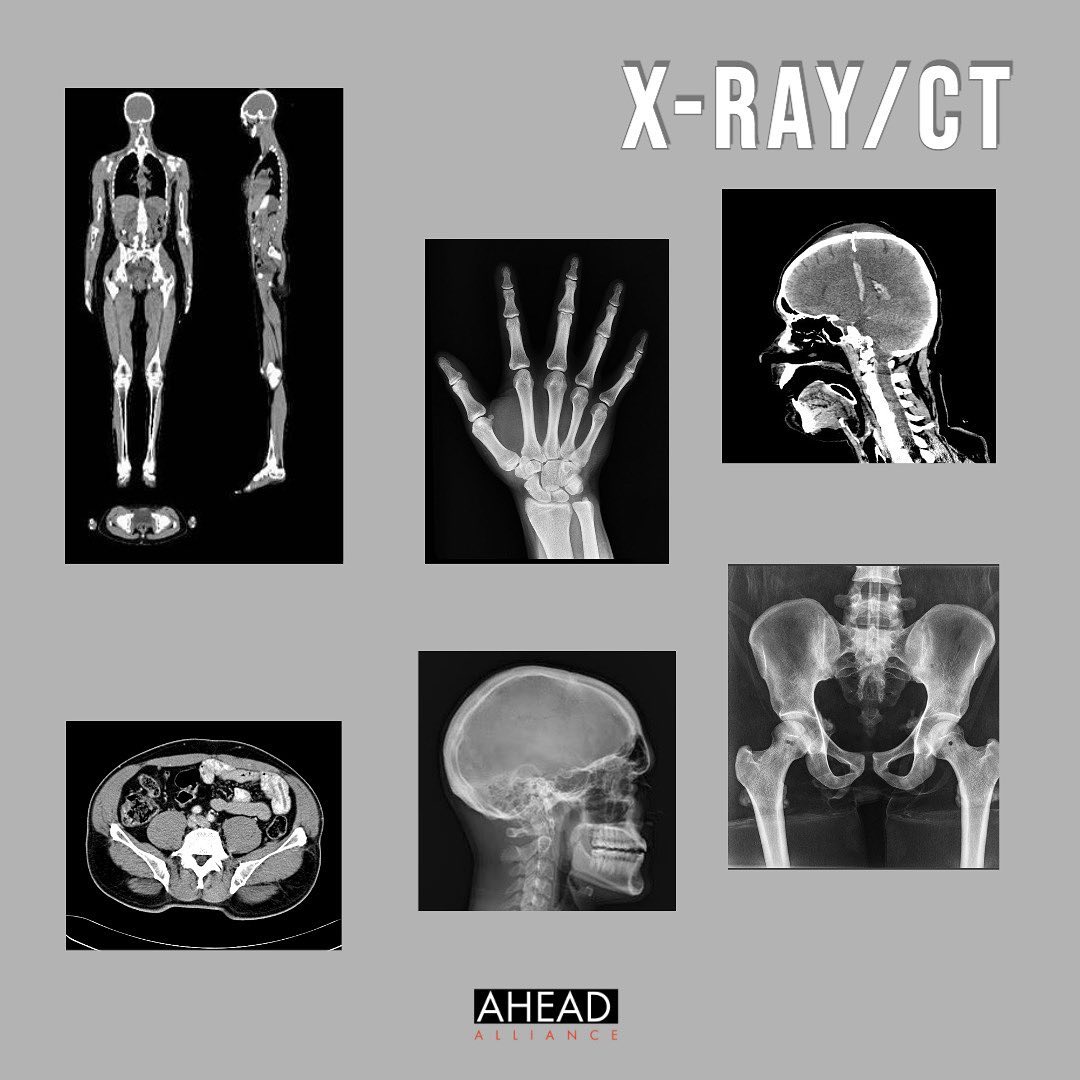 X-ray and CT are imaging techniques that are essential to diagnosis, treatment, and monitoring or patients. Development of these imaging techniques over the years mean that clinicians can plan ahead and make better…

📸 instagram.com/p/CCoMdS0hnbm/ via tweet.photo