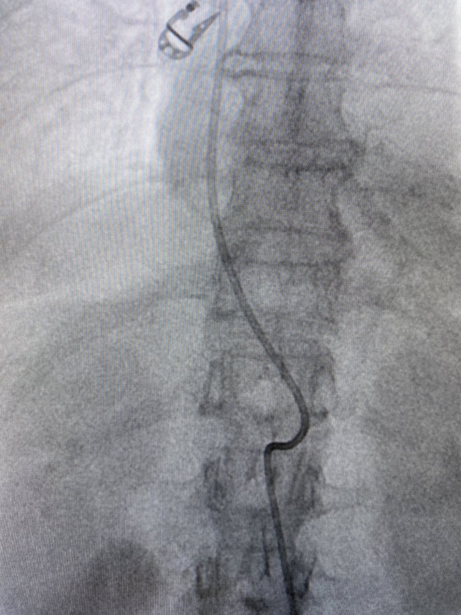 The British Society of Interventional Radiology (@bsir_news) on Twitter photo What is going on in this image?
#Irad #TwittIR <a href="/TraineesBSIR/">BSIR Trainees (British Society of IR Trainees)</a> <a href="/TraineesBSIR/">BSIR Trainees (British Society of IR Trainees)</a> <a href="/SIRRFS/">SIR RFS</a> <a href="/SIR_ECS/">SIR ECS</a> <a href="/RCRadiologists/">The Royal College of Radiologists</a> <a href="/interadiologist/">Dr Sachin Modi</a> <a href="/IRdoctoruk/">Ben Maher</a> What is going on in this image?
#Irad #TwittIR <a href="/TraineesBSIR/">BSIR Trainees (British Society of IR Trainees)</a> <a href="/TraineesBSIR/">BSIR Trainees (British Society of IR Trainees)</a> <a href="/SIRRFS/">SIR RFS</a> <a href="/SIR_ECS/">SIR ECS</a> <a href="/RCRadiologists/">The Royal College of Radiologists</a> <a href="/interadiologist/">Dr Sachin Modi</a> <a href="/IRdoctoruk/">Ben Maher</a>
