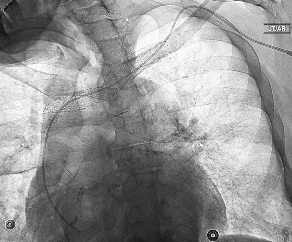 Venkat Tummala MD (@t_intheleadcoat) on Twitter photo Long term #IV #access in pts with occluded #IJ, #EJ, central venous #stents, what’s your access preference ..
1. Supraclavicular #subclavian
2. Conventional subclavian
3. Femoral vein
#IRad <a href="/SIRRFS/">SIR RFS</a> <a href="/SIR_ECS/">SIR ECS</a> <a href="/VenousSymposium/">Venous Symposium</a> <a href="/VenousNews/">Venous News</a> @VeinForum <a href="/EVToday/">Endovascular Today</a> <a href="/JVIRmedia/">JVIR</a> <a href="/CAIRweb/">Canadian Association for Interventional Radiology</a> Long term #IV #access in pts with occluded #IJ, #EJ, central venous #stents, what’s your access preference ..
1. Supraclavicular #subclavian
2. Conventional subclavian
3. Femoral vein
#IRad <a href="/SIRRFS/">SIR RFS</a> <a href="/SIR_ECS/">SIR ECS</a> <a href="/VenousSymposium/">Venous Symposium</a> <a href="/VenousNews/">Venous News</a> @VeinForum <a href="/EVToday/">Endovascular Today</a> <a href="/JVIRmedia/">JVIR</a> <a href="/CAIRweb/">Canadian Association for Interventional Radiology</a>