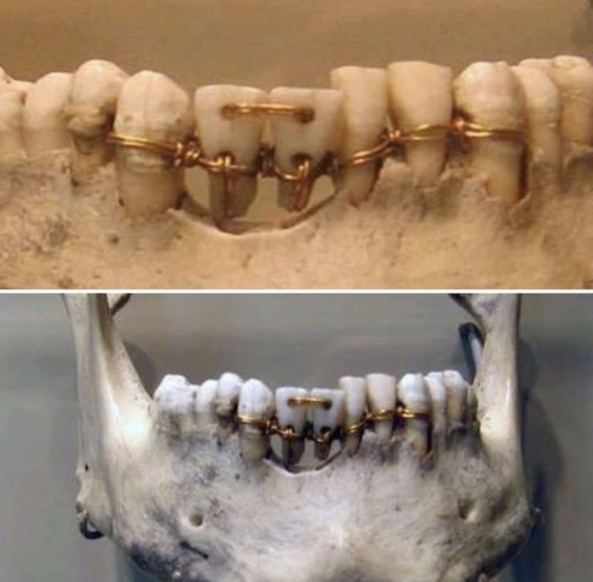 HistoryInPics's tweet photo. Ancient Egyptian dental work from 2000 BC. In many instances these procedures were performed after death. Egyptians placed value on the appearance of the dead to ensure they were sent off correctly to the afterlife. https://t.co/HmzcO5SgJn